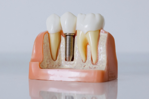 Página de Vendas - Implante Dentário.